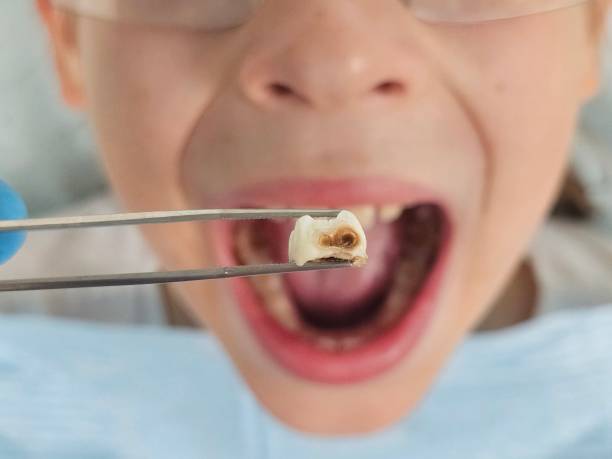Best Emergency Dental Filling Replacement  in Oberlin, OH